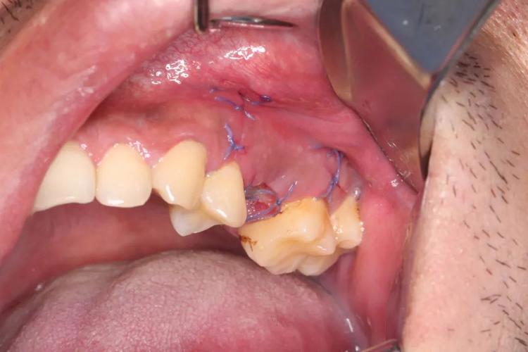 牙齿矫正拔双尖牙,真的有必要吗?会有啥影响?-图2 牙齿矫正拔双尖牙,真的有必要吗?会有啥影响?-图2