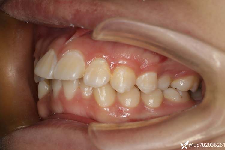 牙齿矫正为何要拔上门牙?拔牙后对美观和功能有何影响?-图1 牙齿矫正为何要拔上门牙?拔牙后对美观和功能有何影响?-图1