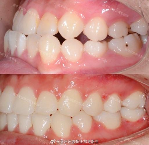 牙齿矫正为何要拔上门牙?拔牙后对美观和功能有何影响?-图3 牙齿矫正为何要拔上门牙?拔牙后对美观和功能有何影响?-图3