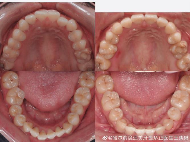 矫正牙齿拔双尖牙-图1 矫正牙齿拔双尖牙-图1