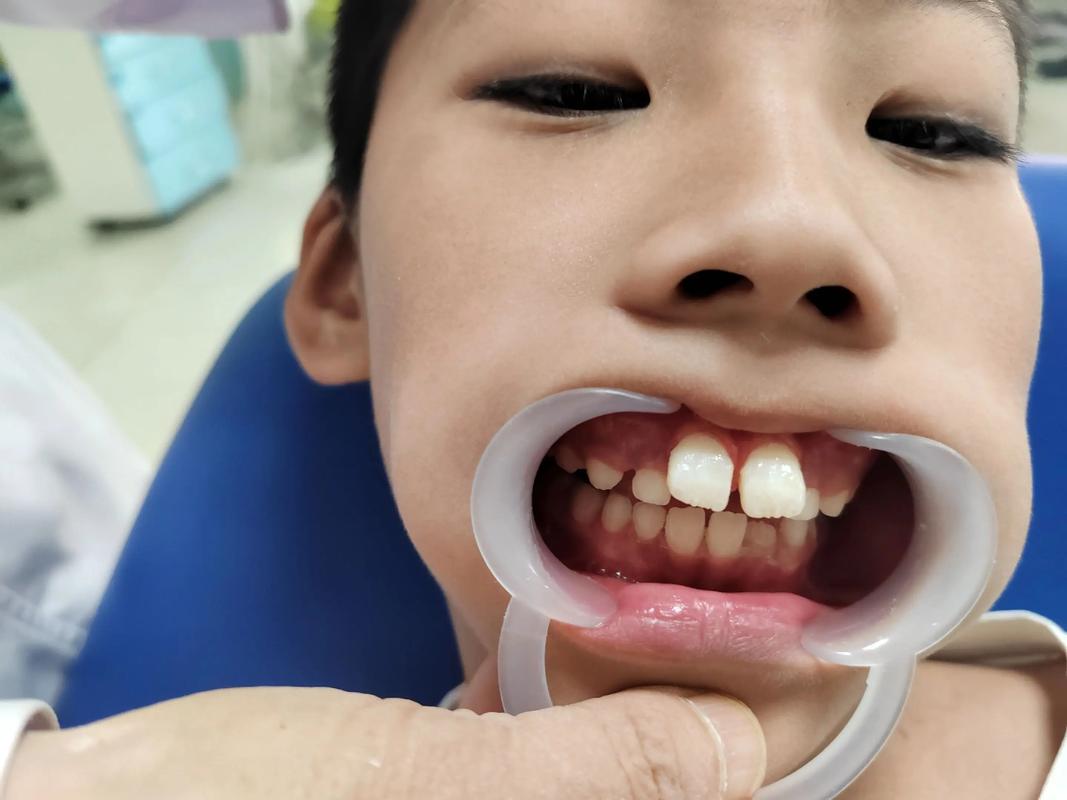 小孩矫正牙齿会有哪些潜在危害?家长必知的健康疑问-图2 小孩矫正牙齿会有哪些潜在危害?家长必知的健康疑问-图2