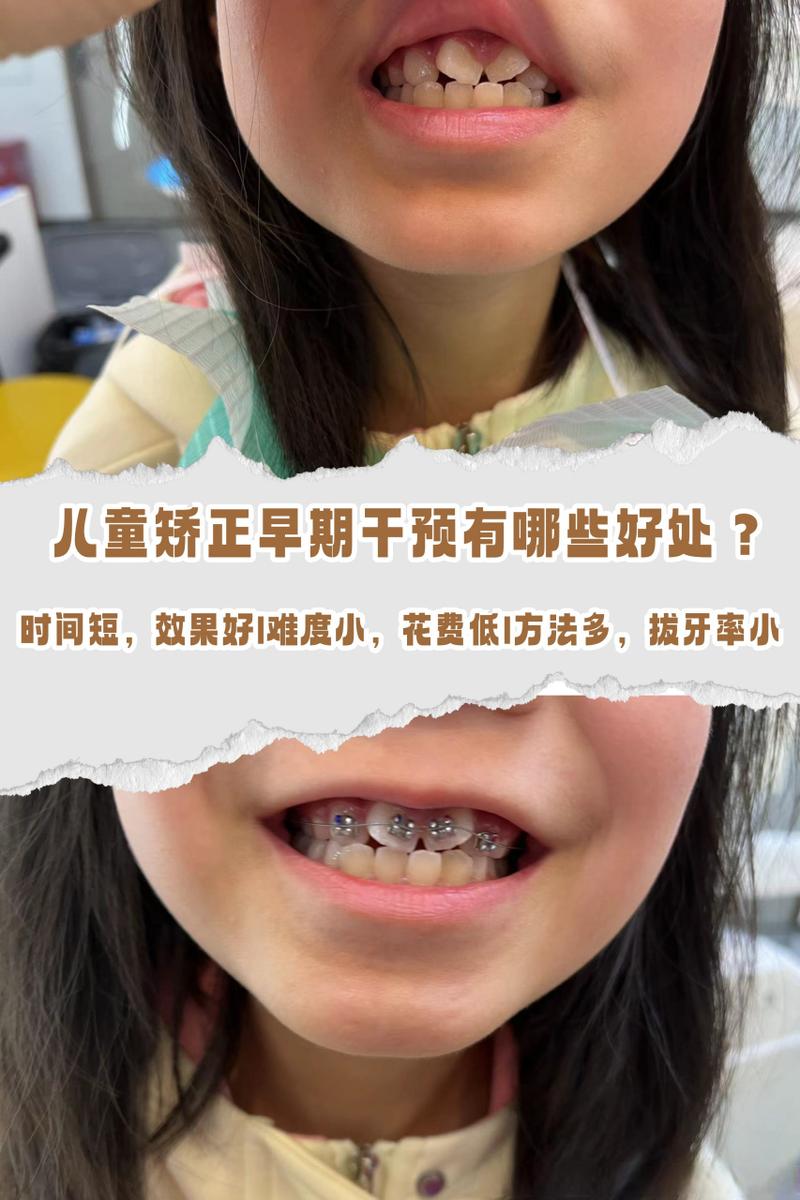 儿童牙齿矫正,几岁开始最合适?如何选方法?-图2 儿童牙齿矫正,几岁开始最合适?如何选方法?-图2