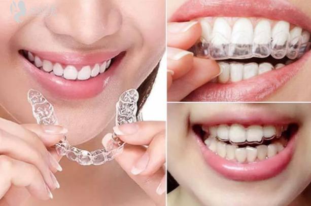 天使隐形矫正牙齿-图2 天使隐形矫正牙齿-图2