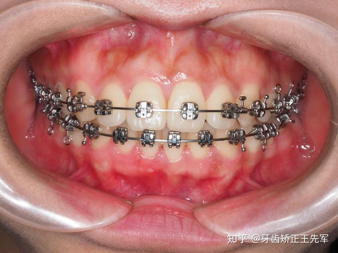 苏州成人牙齿矫正效果如何?要多久见效?-图1 苏州成人牙齿矫正效果如何?要多久见效?-图1