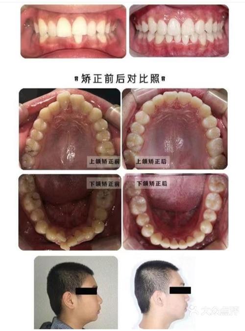 厦门牙齿矫正对比-图1 厦门牙齿矫正对比-图1