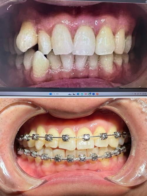 华西医院矫正牙齿效果如何?价格贵吗?流程复杂吗?-图1 华西医院矫正牙齿效果如何?价格贵吗?流程复杂吗?-图1