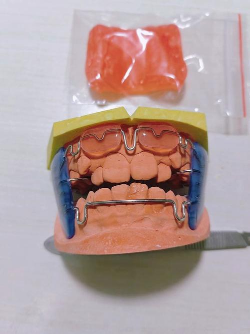 牙齿反合的矫正器-图2 牙齿反合的矫正器-图2