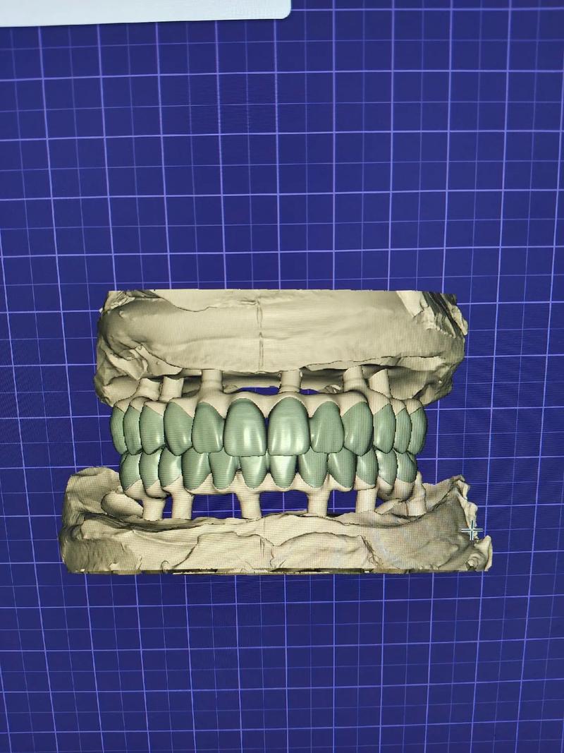 3d牙齿矫正技术-图2 3d牙齿矫正技术-图2