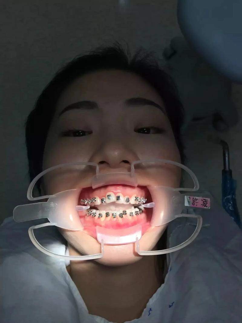 40岁矫正牙齿还来得及吗?效果会受年龄影响吗?-图2 40岁矫正牙齿还来得及吗?效果会受年龄影响吗?-图2