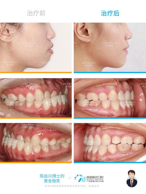 牙齿地包天矫正后-图2