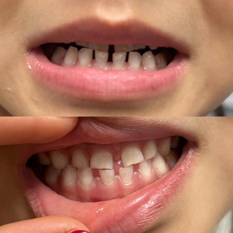 牙齿地包天矫正后-图3