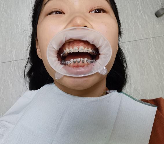 23岁做牙齿矫正-图1
