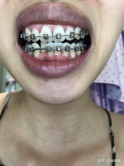 23岁做牙齿矫正-图2