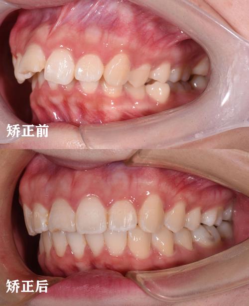 20岁后矫正牙齿-图3 20岁后矫正牙齿-图3