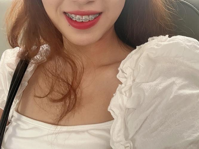 在合肥做牙齿矫正-图1 在合肥做牙齿矫正-图1