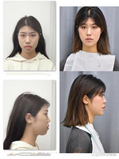 矫正牙齿脸型对比-图3