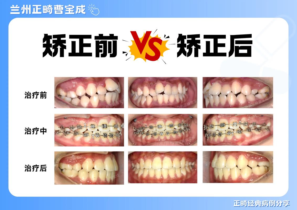 牙齿矫正的变化过程具体会经历哪些关键阶段和变化步骤?-图1 牙齿矫正的变化过程具体会经历哪些关键阶段和变化步骤?-图1