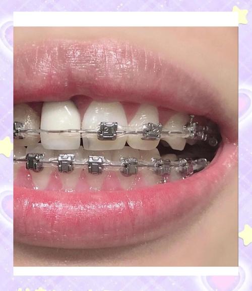 牙齿矫正戴橡皮圈-图2 牙齿矫正戴橡皮圈-图2