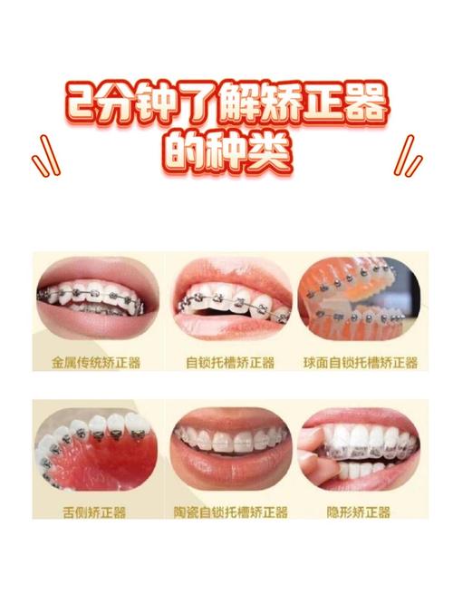牙齿矫正器有哪些？常见类型怎么选？-图3