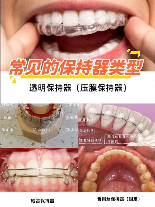 牙齿矫正器有哪几种?不同类型怎么选?-图1 牙齿矫正器有哪几种?不同类型怎么选?-图1