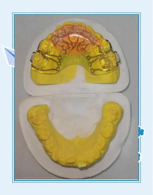 牙齿矫正器有哪几种?不同类型怎么选?-图2 牙齿矫正器有哪几种?不同类型怎么选?-图2