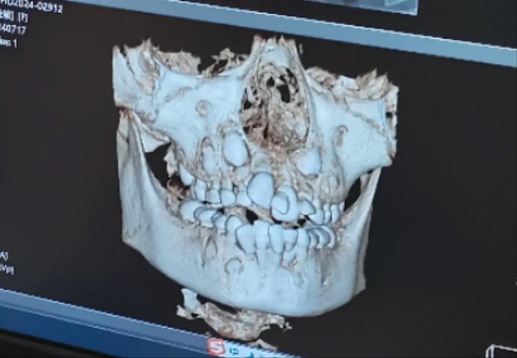 矫正牙拍牙齿ct-图1