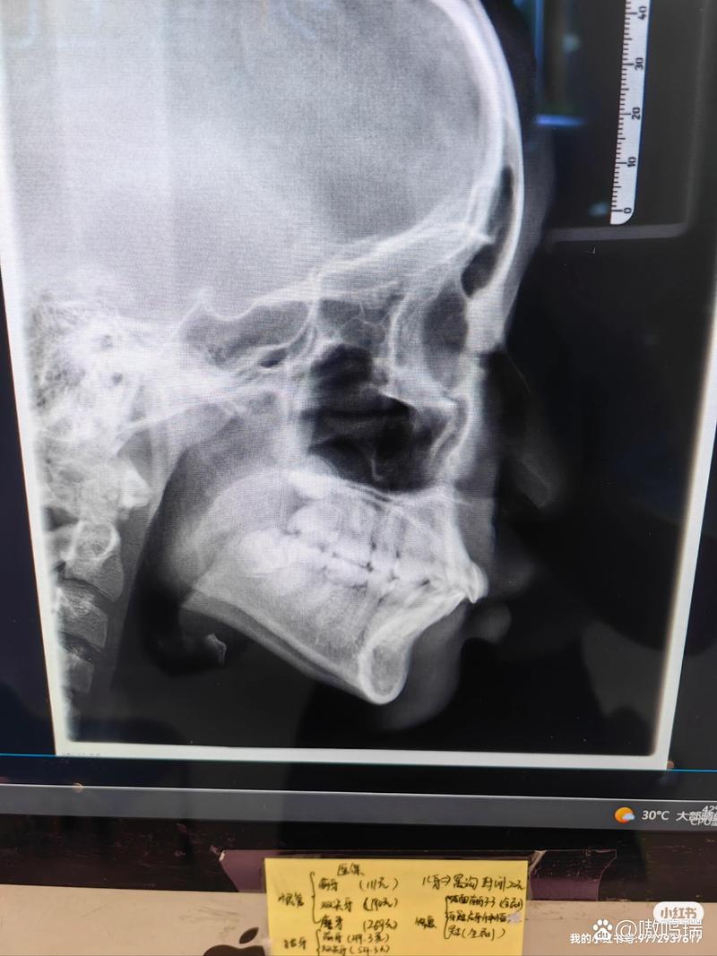 矫正牙拍牙齿ct-图2