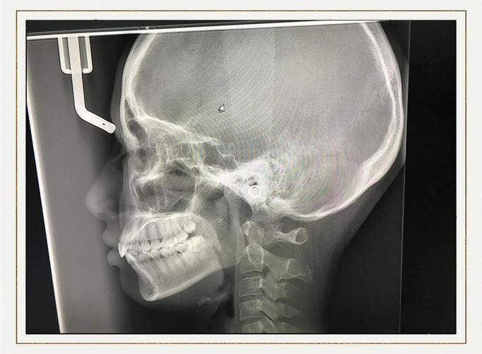 矫正牙拍牙齿ct-图3