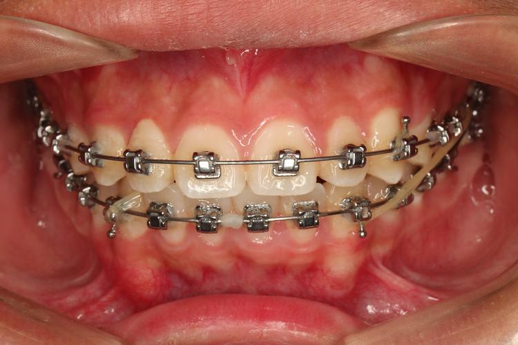 成人矫正牙套效果好吗？适合哪些情况？-图1