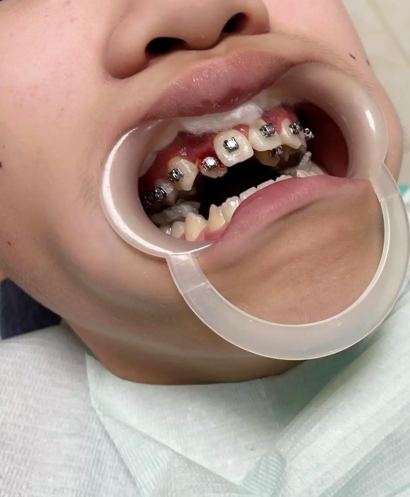 矫正牙齿后长智齿-图1