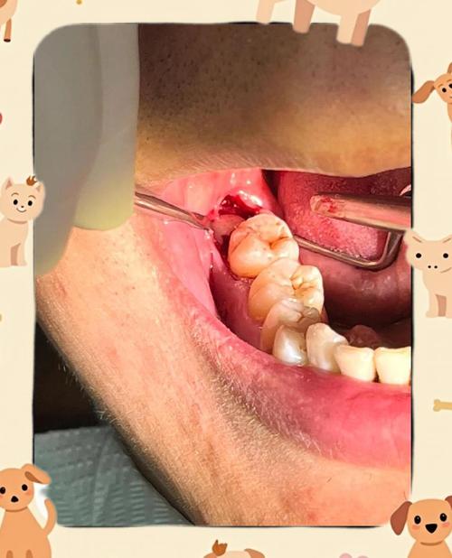 矫正牙齿后长智齿-图3