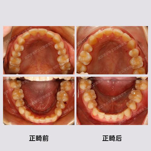武汉同济矫正牙齿效果如何?医生靠谱吗?价格贵不贵?-图1 武汉同济矫正牙齿效果如何?医生靠谱吗?价格贵不贵?-图1