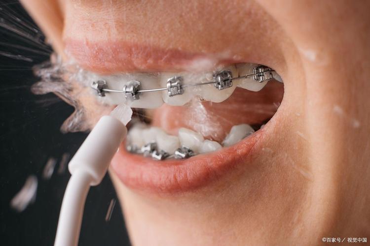 钢丝矫正牙齿图片,能看出牙齿矫正的真实效果吗?-图2 钢丝矫正牙齿图片,能看出牙齿矫正的真实效果吗?-图2