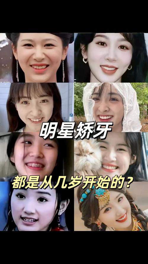 哪些明星悄悄矫正过牙齿？-图1