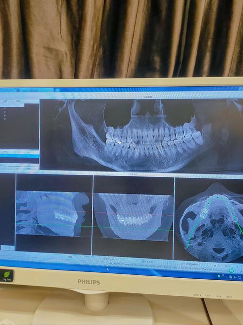 牙齿矫正拍CT是必须的吗？关键作用与检查重点解析-图1