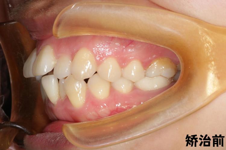 牙齿矫正为何要磨牙？磨小牙齿有风险吗？-图1