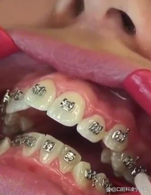 矫正完的牙齿松动-图1 矫正完的牙齿松动-图1