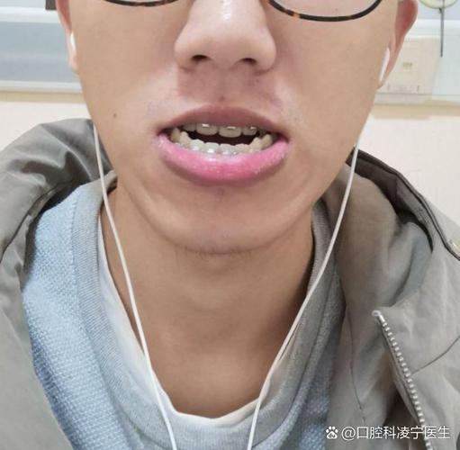 矫正完的牙齿松动-图2 矫正完的牙齿松动-图2