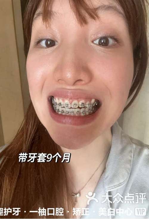 矫正完的牙齿松动-图3 矫正完的牙齿松动-图3