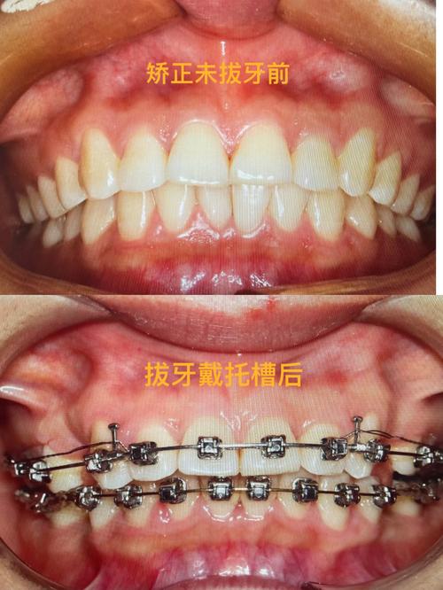 矫正牙齿前的拔牙-图1 矫正牙齿前的拔牙-图1