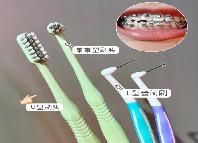 矫正牙齿期间能正常刷牙吗?-图2 矫正牙齿期间能正常刷牙吗?-图2