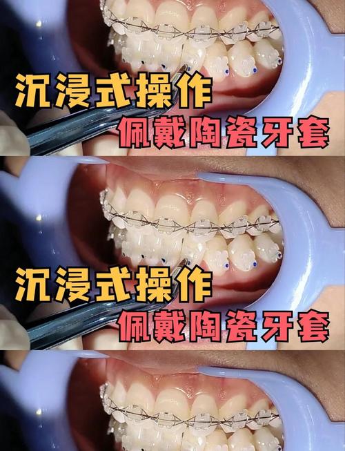牙齿矫正陶瓷牙套-图1 牙齿矫正陶瓷牙套-图1