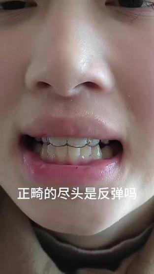 矫正牙齿后反弹风险大吗？原因是什么？如何科学预防反弹？-图2