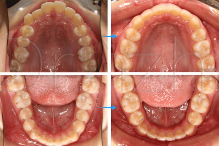 矫正牙齿拔两颗牙是必须的吗？对牙齿健康和排列有何影响？-图3