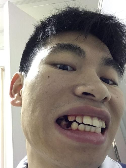 矫正牙齿拔两颗牙是必须的吗？对牙齿健康和排列有何影响？-图2