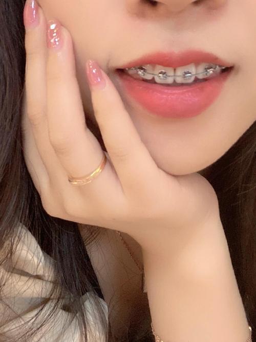 三十岁做牙齿矫正-图1