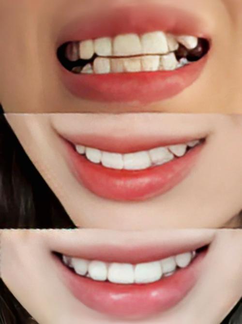 三十岁做牙齿矫正-图2