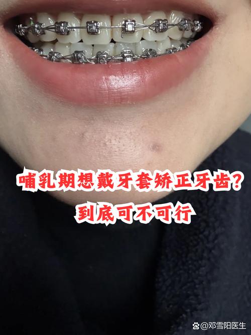 哺乳期做牙齿矫正,宝宝安全吗?-图1 哺乳期做牙齿矫正,宝宝安全吗?-图1