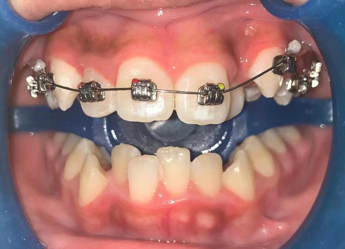 牙齿矫正后牙槽掉了该怎么办？-图1