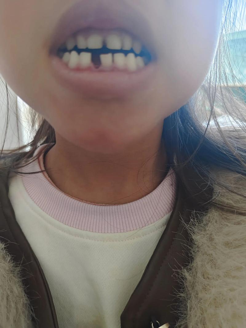 牙齿矫正后牙槽掉了该怎么办？-图3